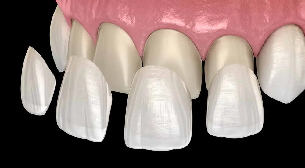 Veneers and Crowns